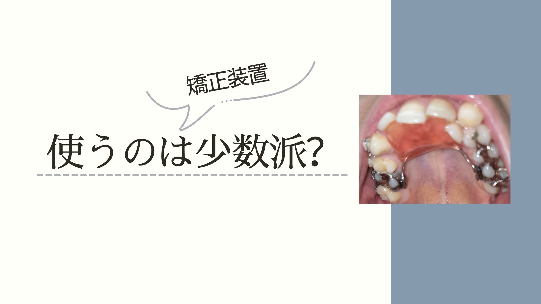歯科矯正でホールディングアーチを使って大変だったこと（噛めない・しゃべれない）をまとめた記事