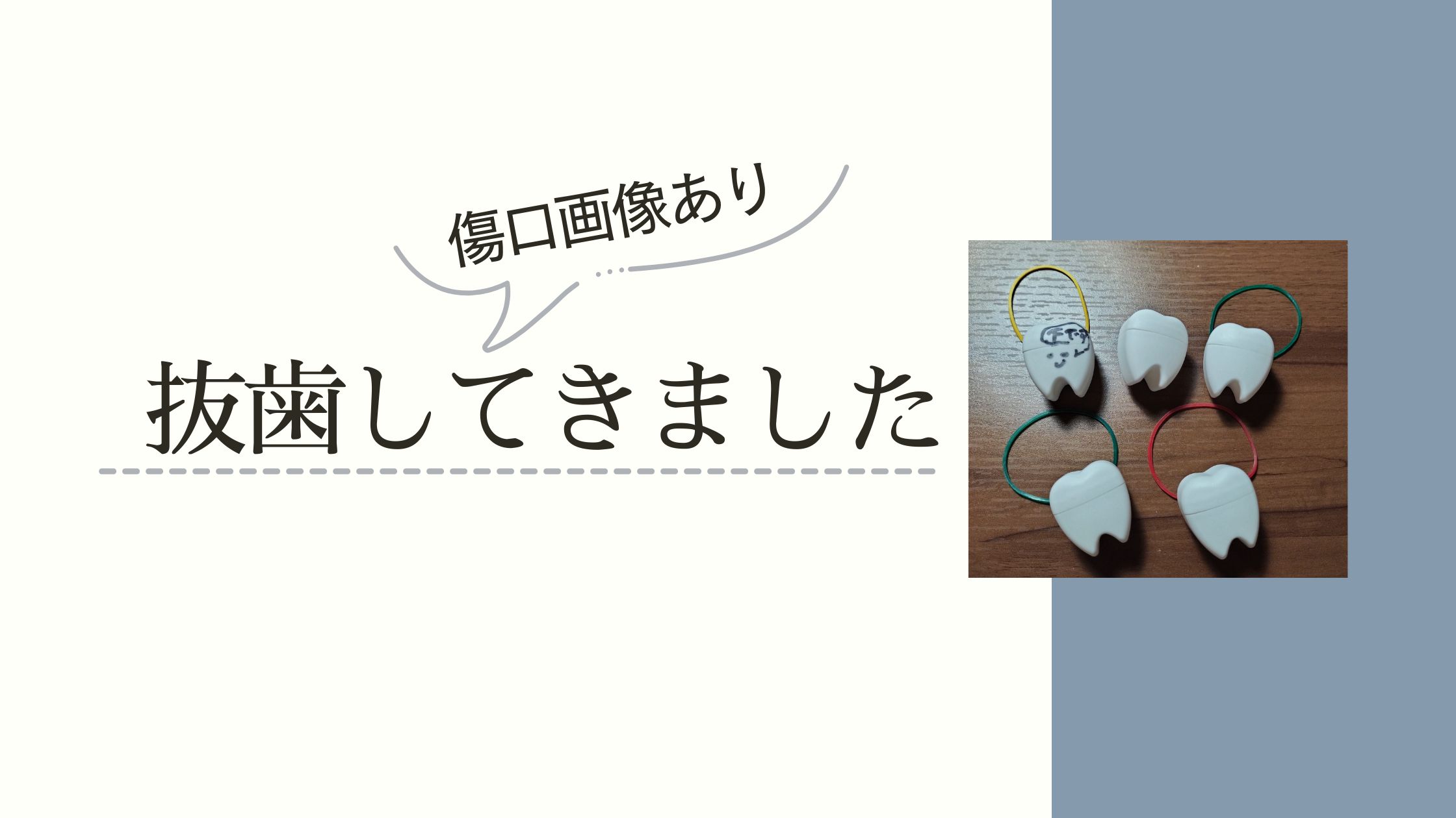 歯科矯正で親知らず4本と4番4本の計8本を抜く私の抜歯レポ