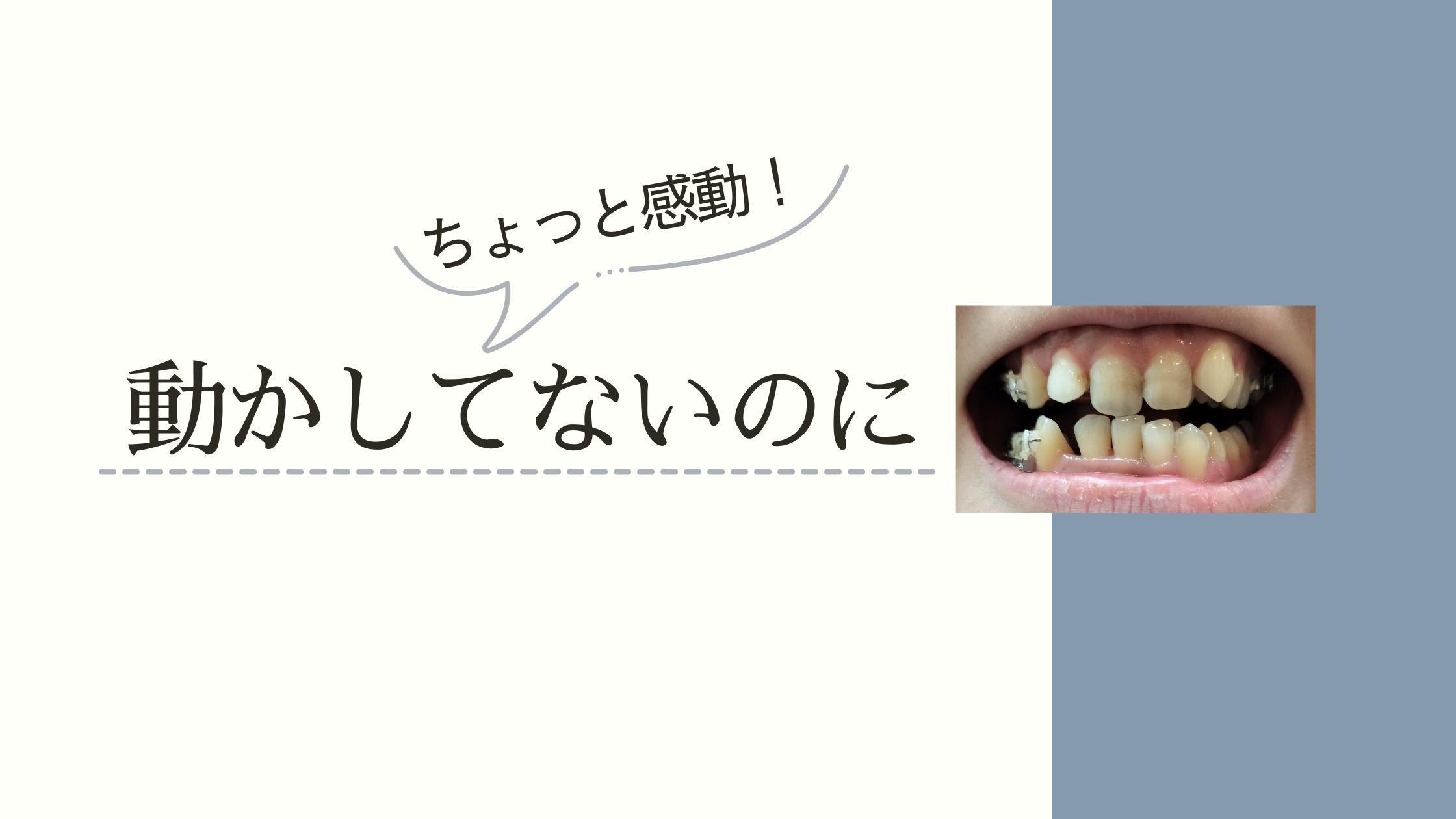 歯科矯正でブラケットをつけていない歯も勝手に動くことに驚いた記事