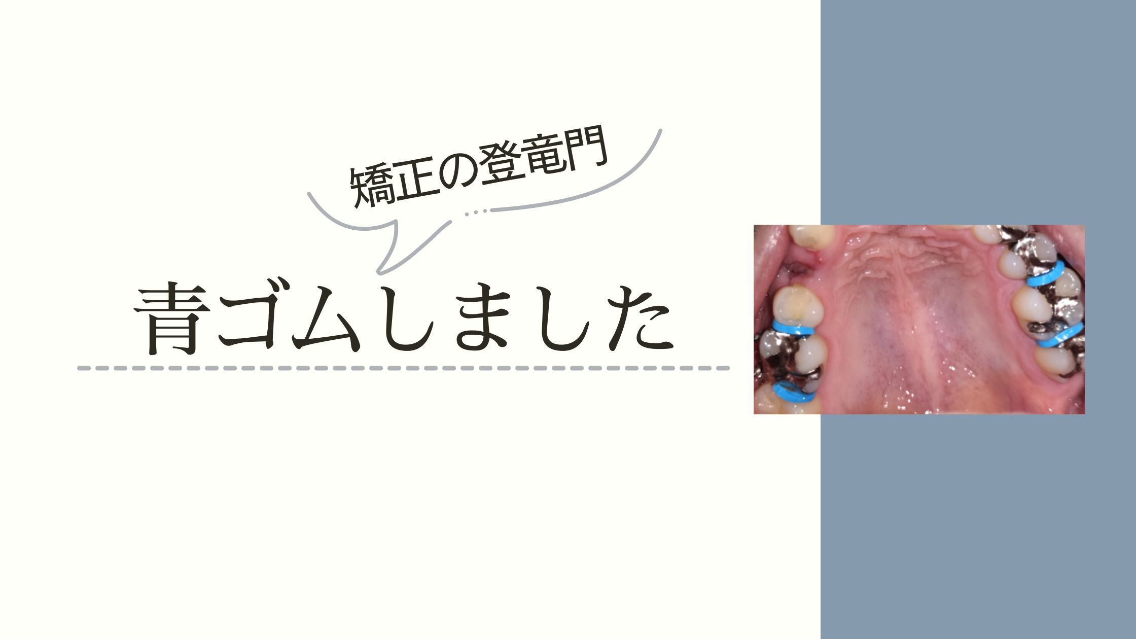 歯科矯正で痛いと言われる青ゴムの実体験レポ